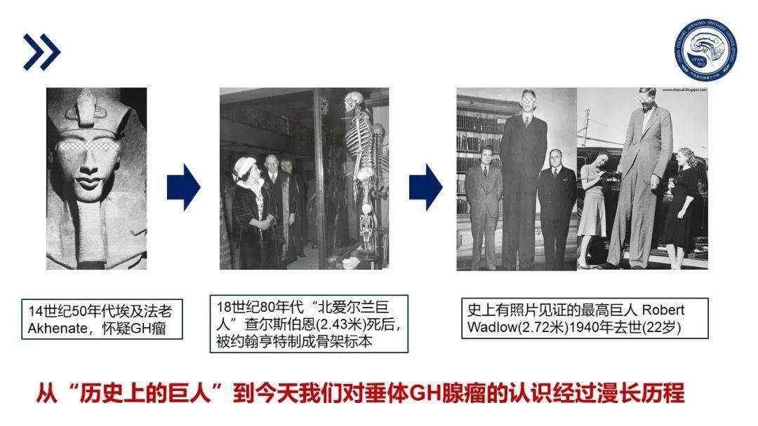 中国肢端肥大症诊治指南2020版重磅发布