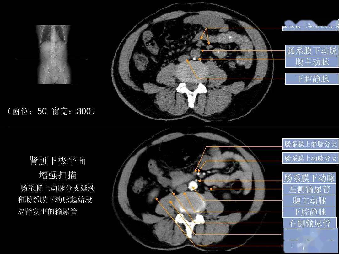 ct扫描定位线解剖图图片