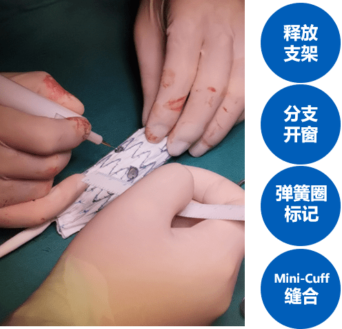 缝合弹簧圈作为术中标记,在这些开口位置再缝合上短支架( mini-cuff