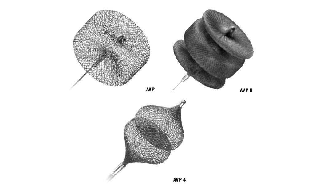 amplatzer血管塞经典病例回顾