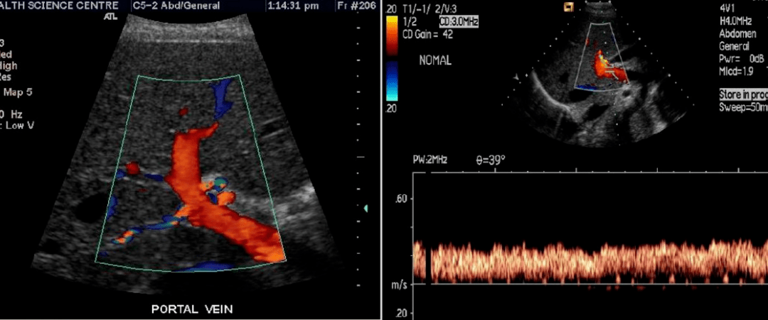 肝脏五叶八段超声图谱图片