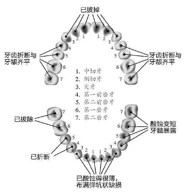 19岁高中生一口牙齿拔掉8颗,折断10颗,他这个习惯很多人都有