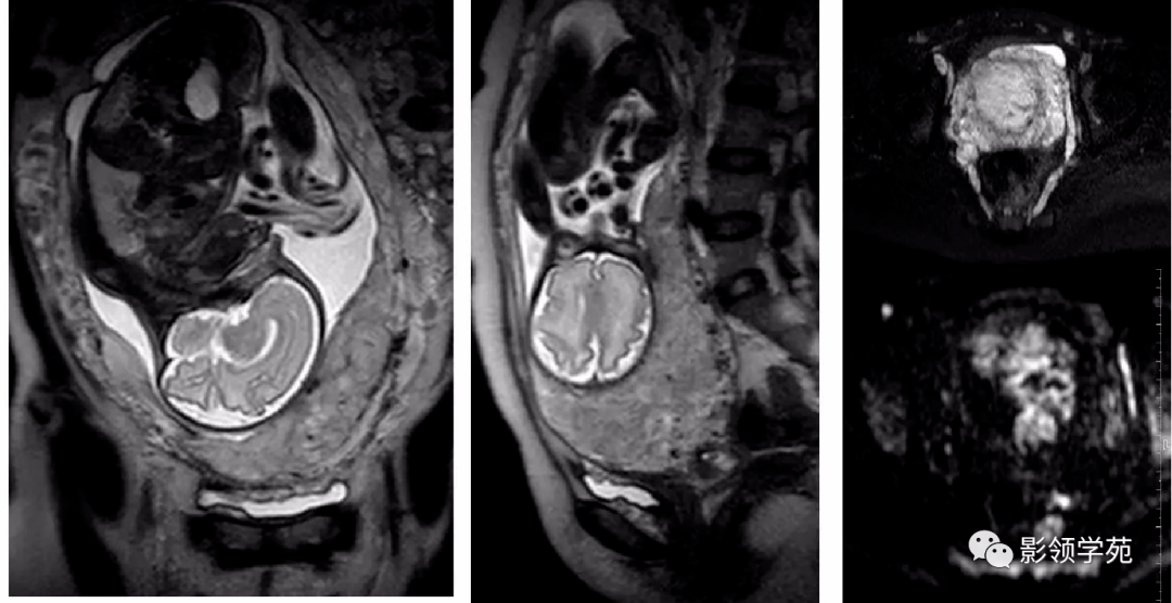 胎盤植入mr診斷