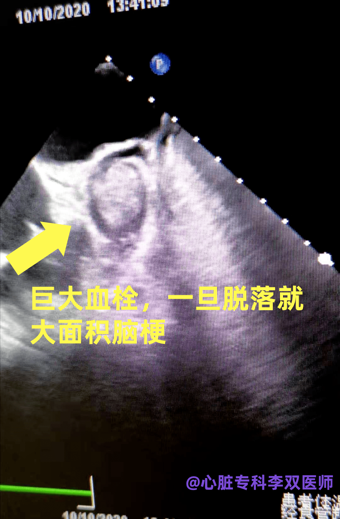 频发房颤左心耳巨大血栓下了3次病危最终好转出院