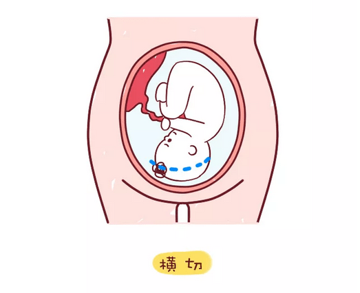 惊险!子宫壁最薄处仅3毫米,瘢痕子宫第二胎顺剖成功
