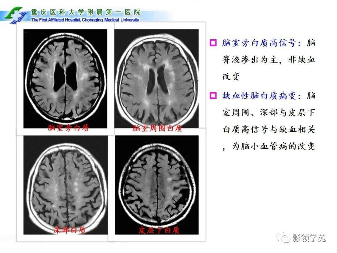 脑白质分区与脑白质高信号脑小血管病