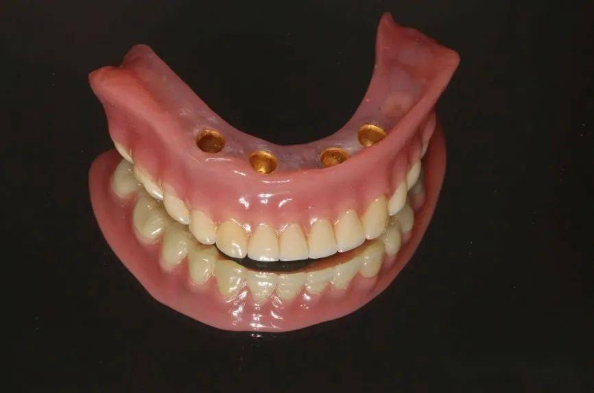 无牙颌种植大赏下颌无牙颌套筒冠固位覆盖义齿修复