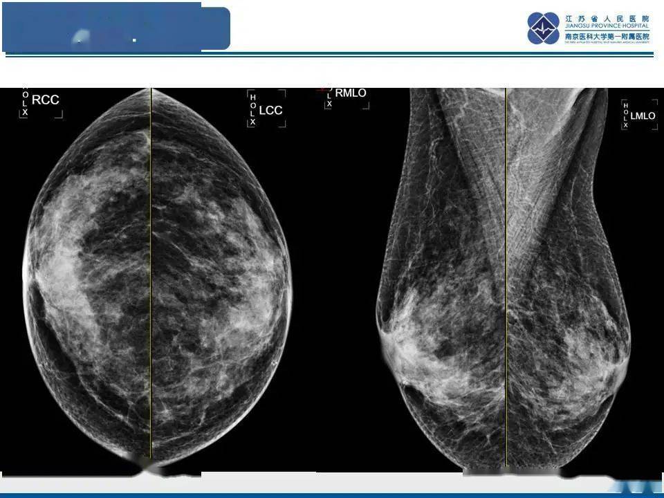 乳腺paget病外观图片图片