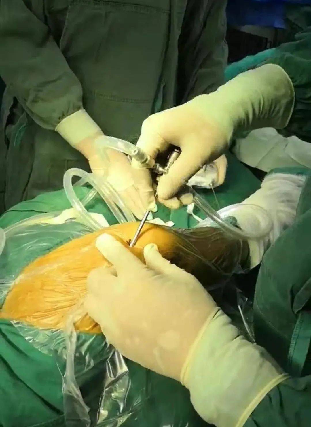 【中西医结合|五医】针刀镜解决大病痛 ——我院首例针刀镜膝关节血肿