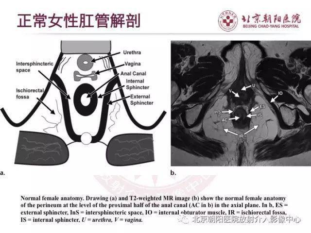 马蹄形肛瘘图片图解图片