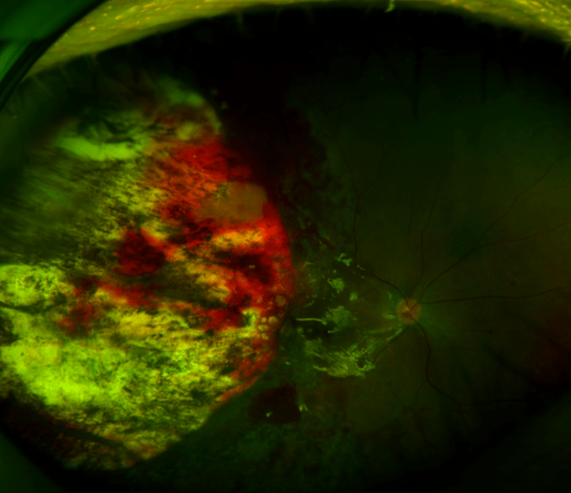 保视力保眼球提高生存率汪朝阳教授谈脉络膜黑色素瘤治疗新进展