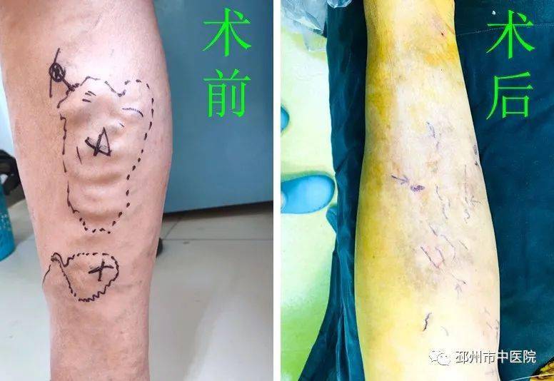 济南下肢静脉曲张治疗：改善生活质量的最佳途径