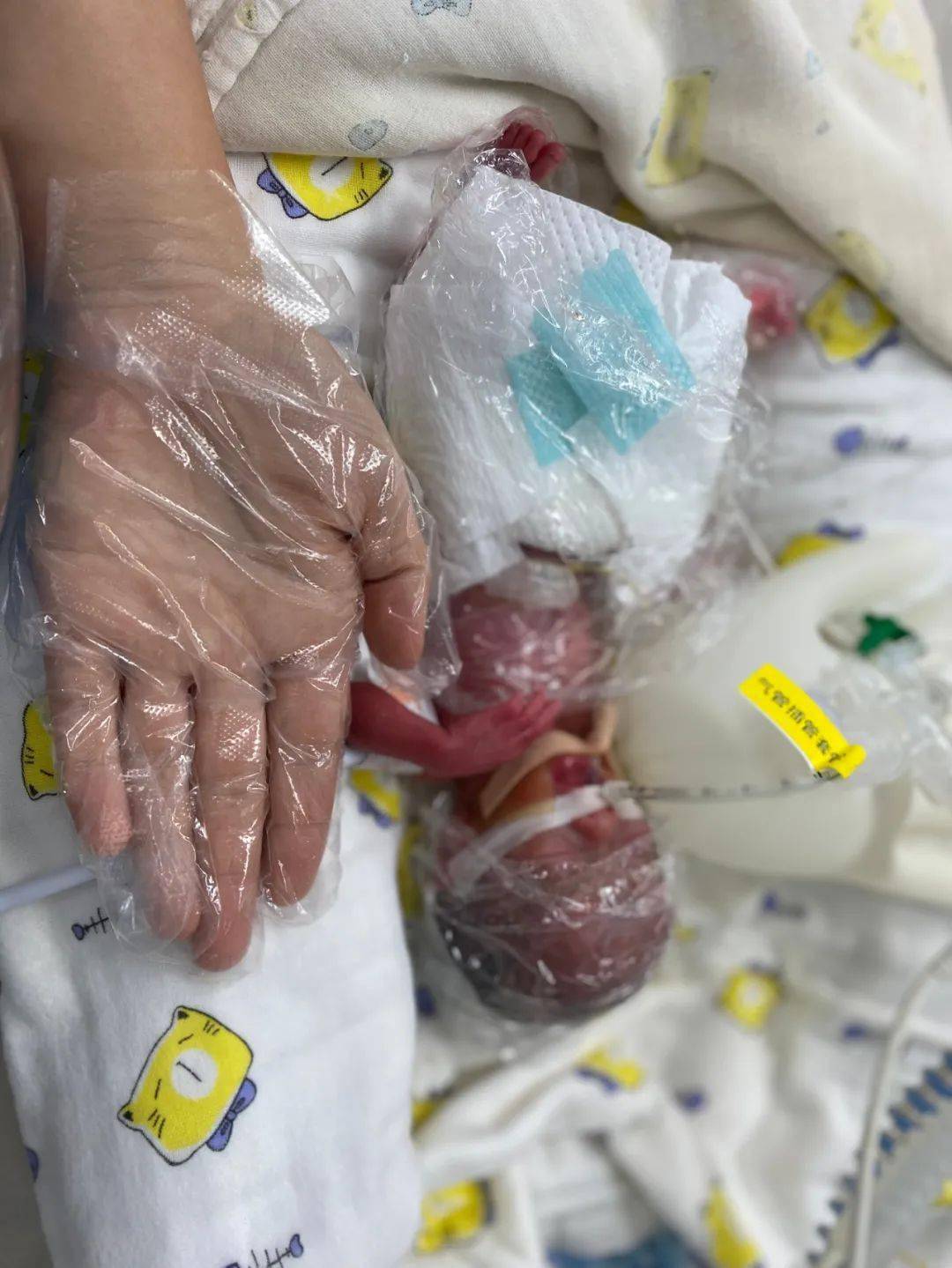 韶关超小巴掌宝宝满月啦出生时仅有495克