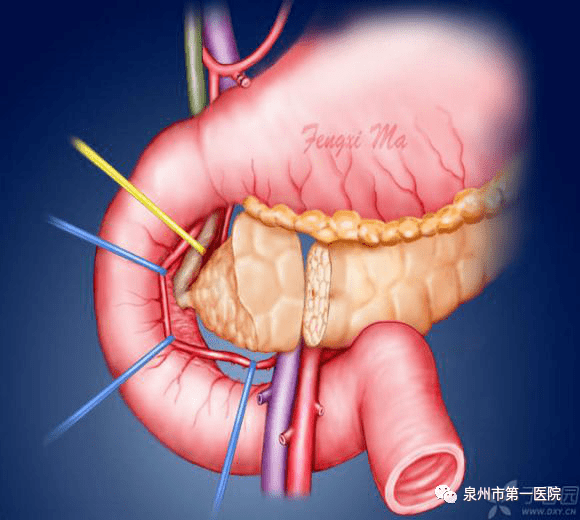 【技術分享】市一院成功開展保留十二指腸全胰頭微創切除術_胰腺