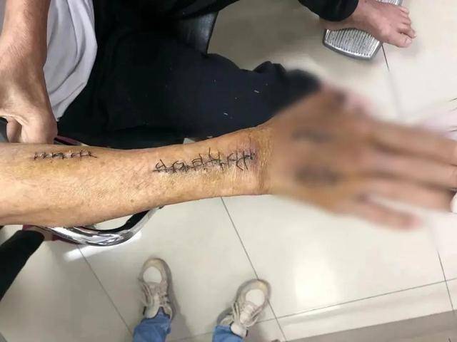 广州一阿伯被海蟹夹伤竟要截指保命