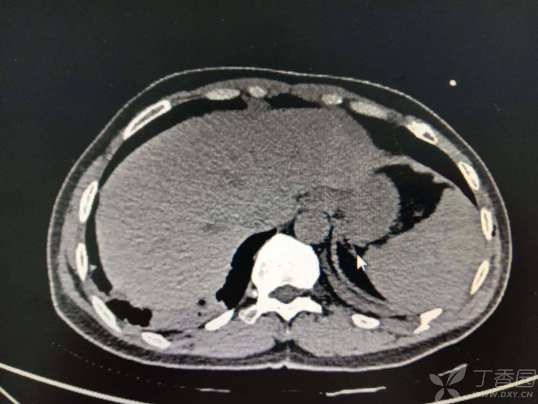 脾破裂ct图片