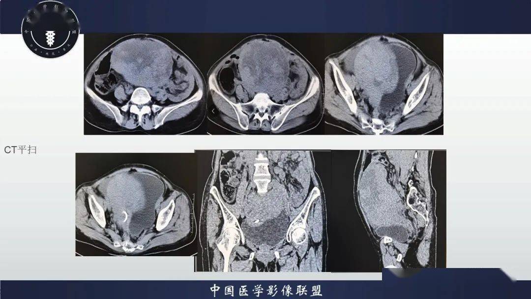 卵巢丨透明细胞癌_手机搜狐网
