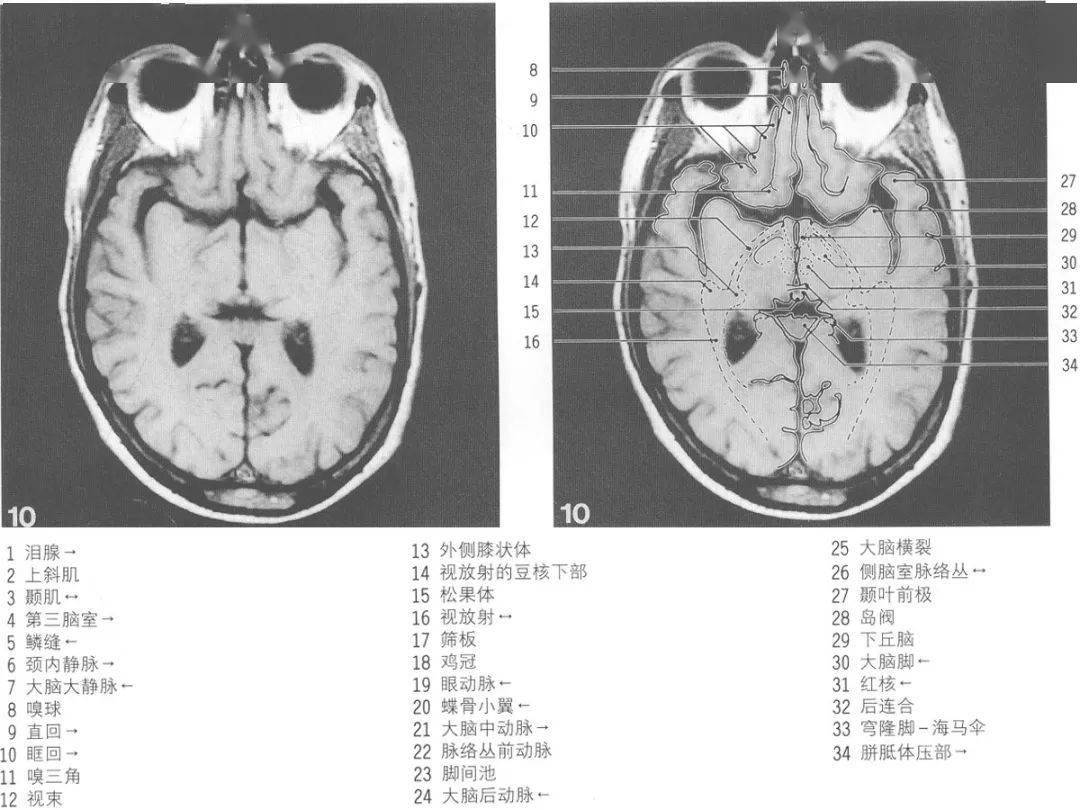 mri顱腦橫斷面解剖圖譜