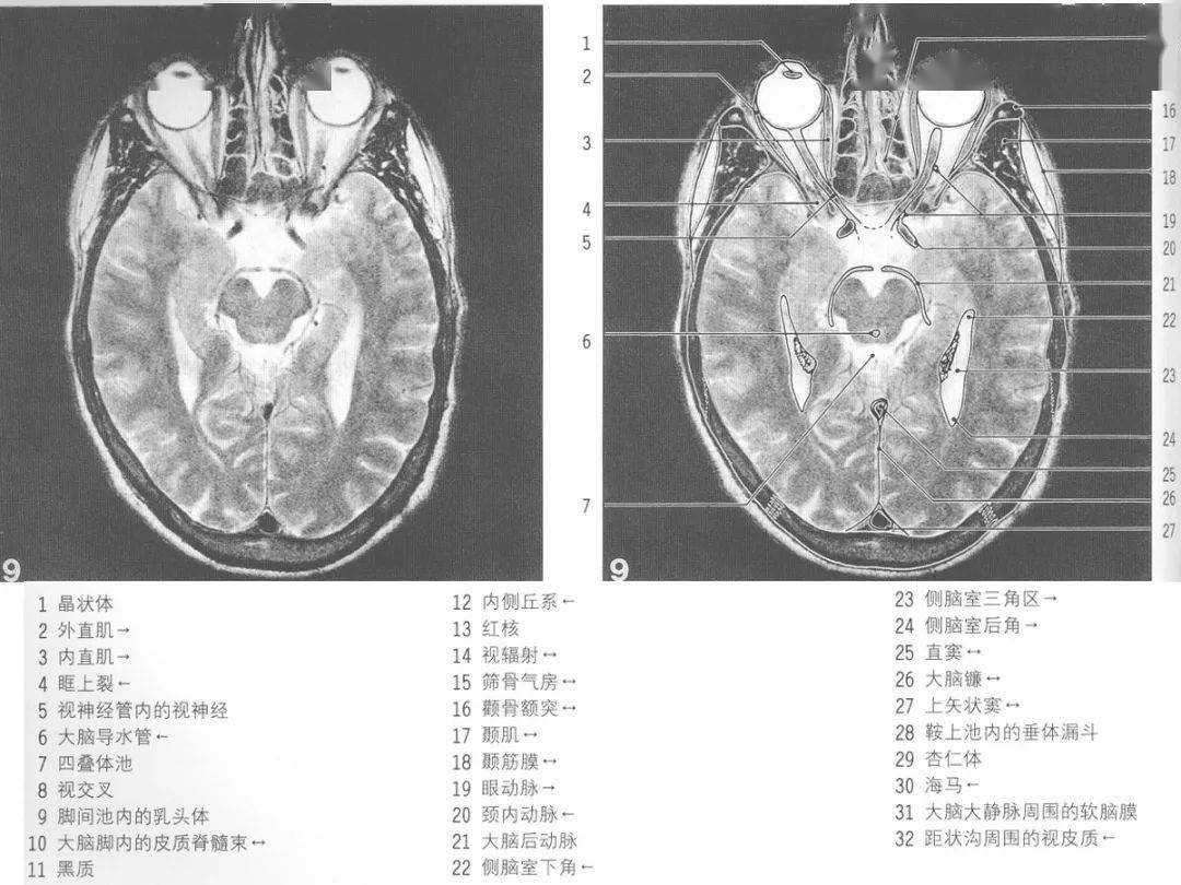 丘脑mri断层解剖图图片