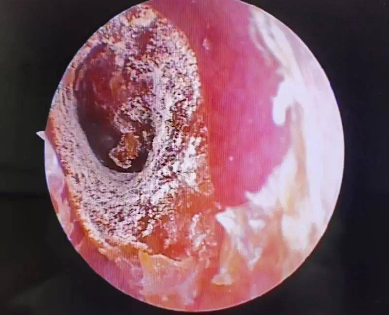 耳道真菌病感染图片