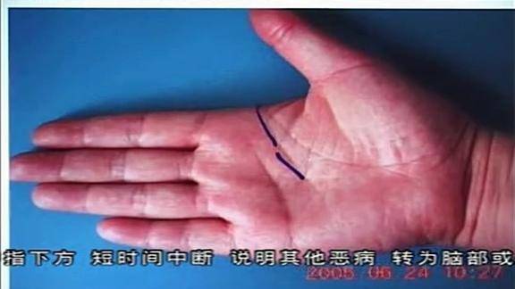 中医诊断-手诊-手掌信息看健康-脑瘤,您看准吗?