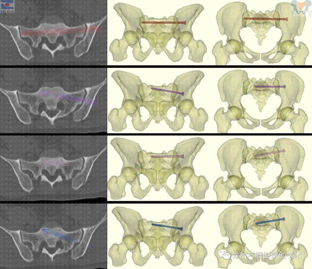 骶髂螺钉正确指向图解通晓规律免除错误远离危险