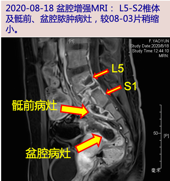 探案丨花季少女盆腔脓肿谁在作怪