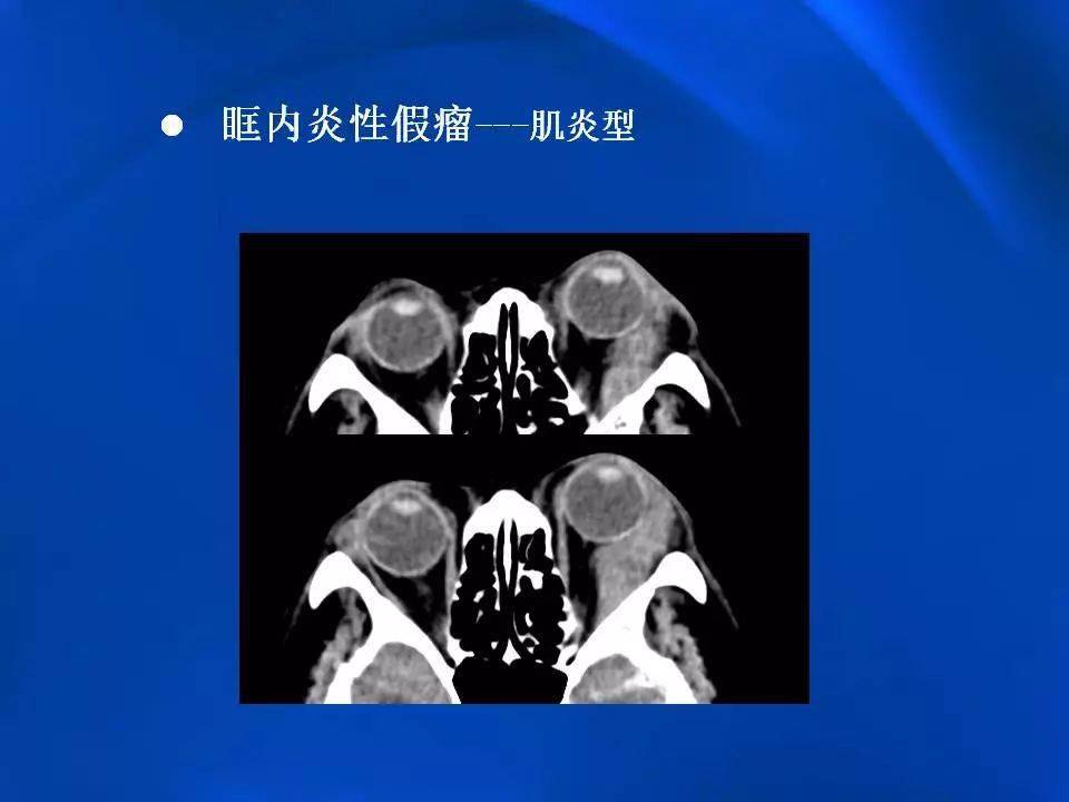 眶内炎性假瘤影像学表现