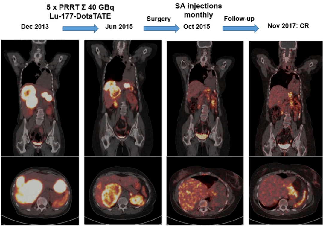 诺华net之声神经内分泌肿瘤文献速递与专家点评19