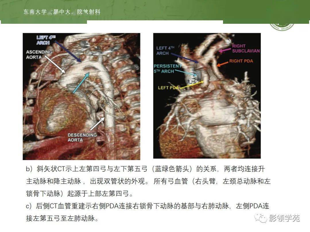 梗阻性先天性主動脈弓畸形包括主動脈縮窄,主動脈離斷,主動脈吧上