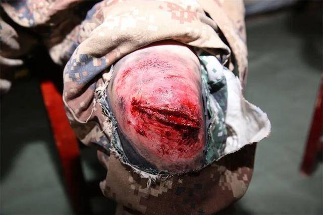 子弟兵受伤的脸图片