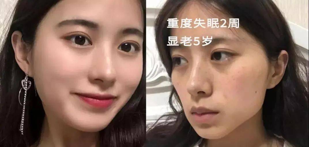 眼角下垂无神,一下子显老5岁就能让人脸部明显老化仅仅5天睡眠不足有