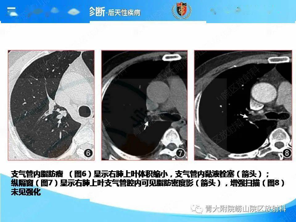 支气管粘液栓图片