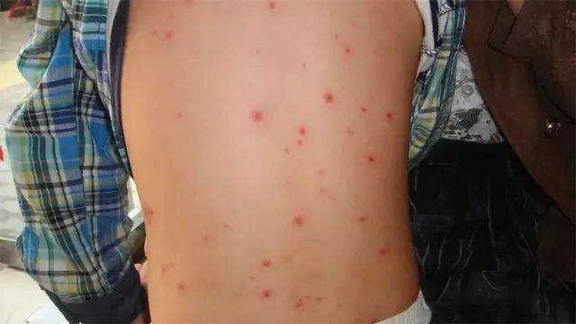这种病进入高发期,孩子如何预防?_水痘