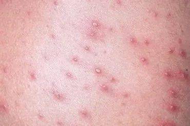 有的孩子一头的癞疮,或者身上一会这里长个结子,那里长个疖子的很普遍