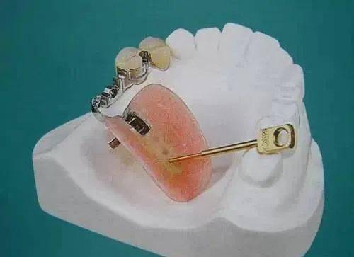 最全的活动假牙的介绍及材料
