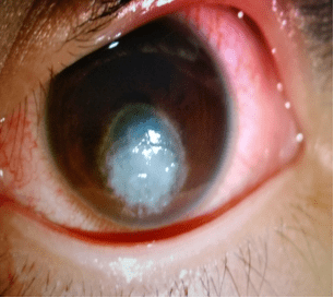 眼角膜发炎的症状图片图片