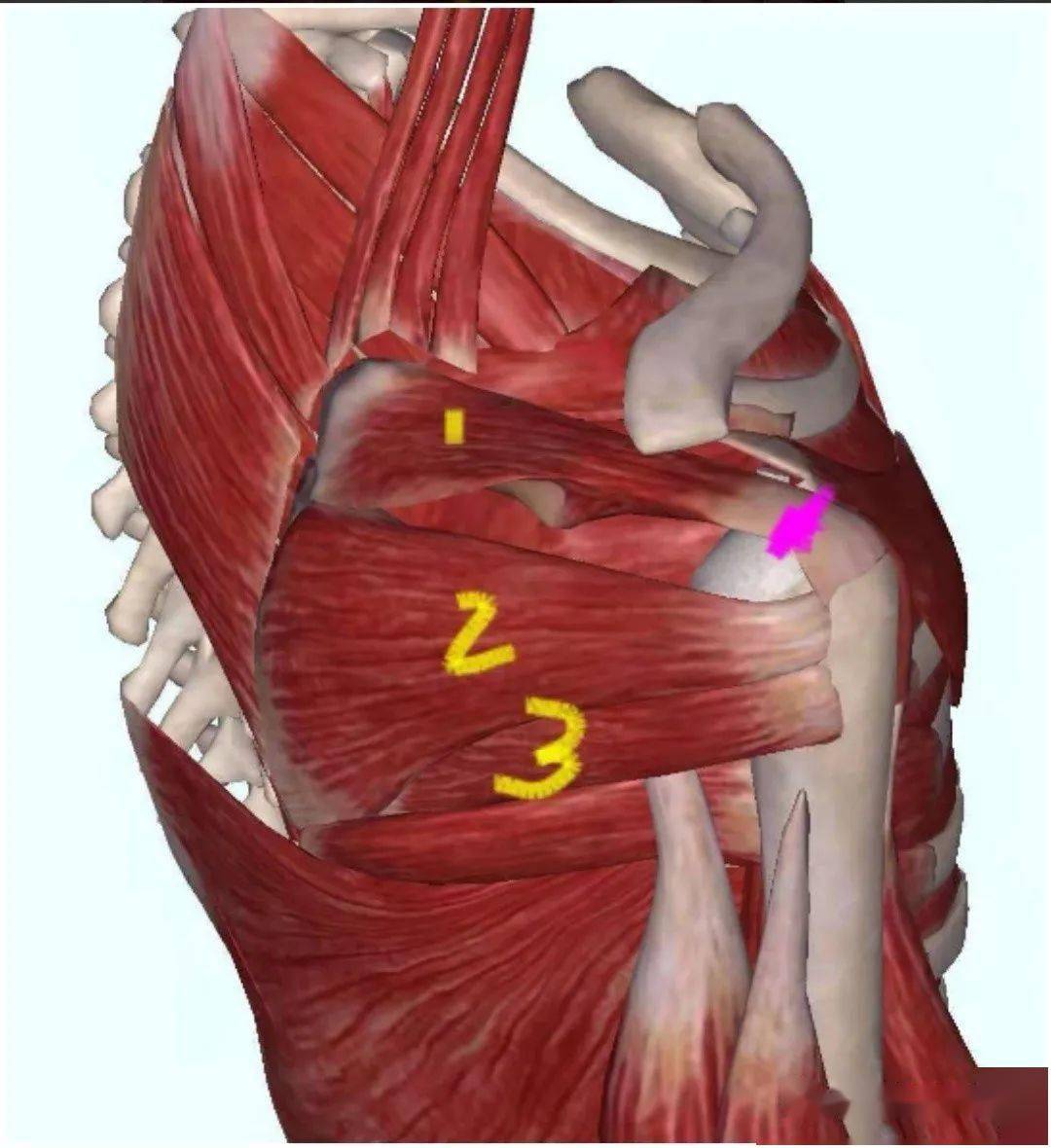 左肩冈上肌腱撕裂图片图片