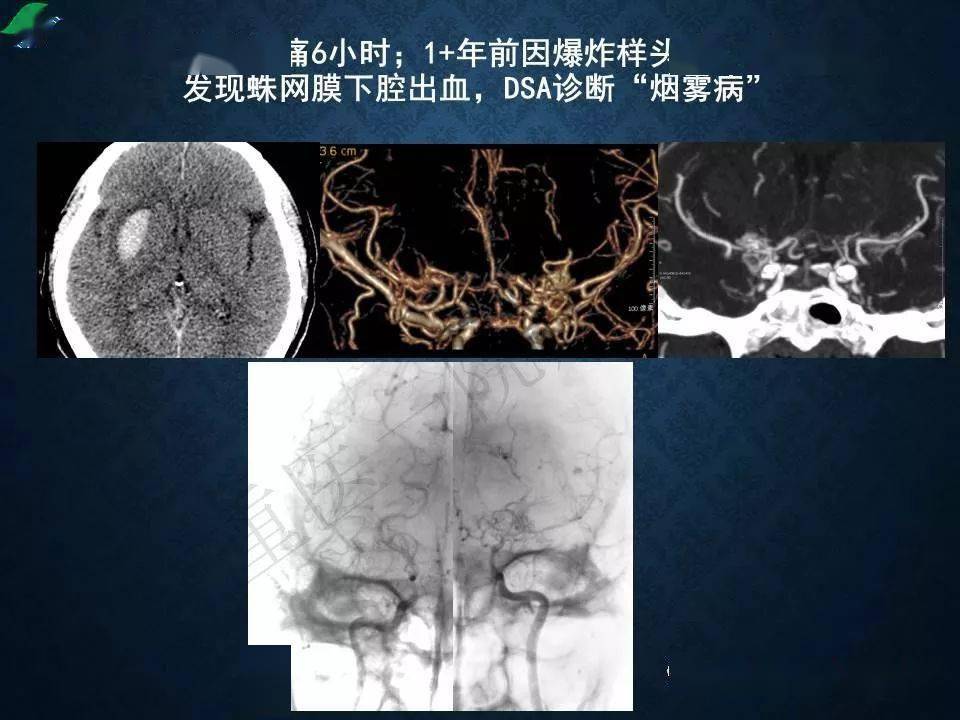 烟雾病的影像学诊断