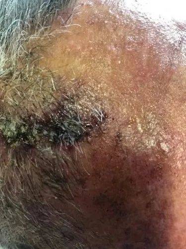 患者陈大伯因"右侧头面部疼痛4天,发现疱疹2天拟带状疱疹神经痛"收治