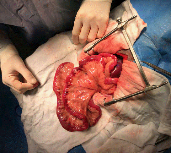 胃切除术解除异物的固定锚点后,将异物轻轻挤入空肠中部,以减轻皱襞