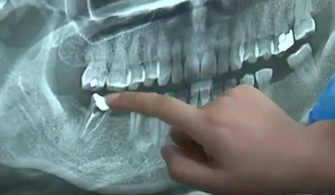 根管治疗后断针需要告知患者吗又该怎么赔偿