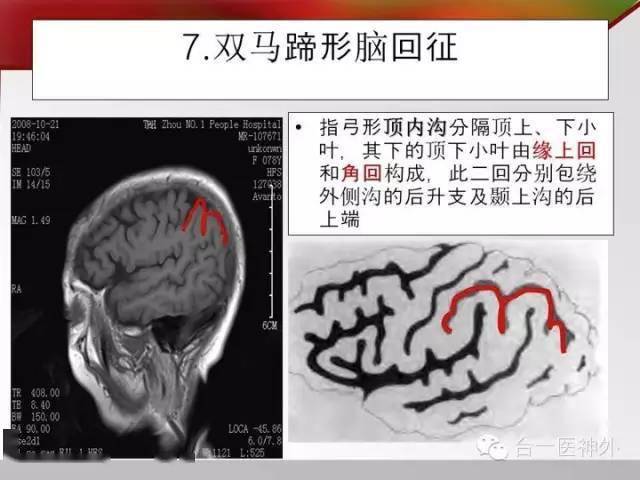 头颅mri矢状面脑沟回七大征象