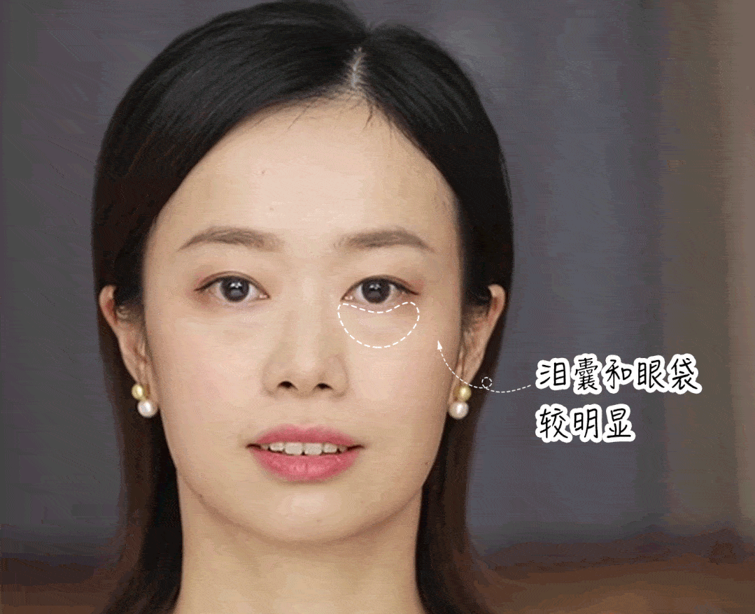 但经过毛老师"换头"后,不仅袋,泪沟全消失,还活生生整出了卧蚕!