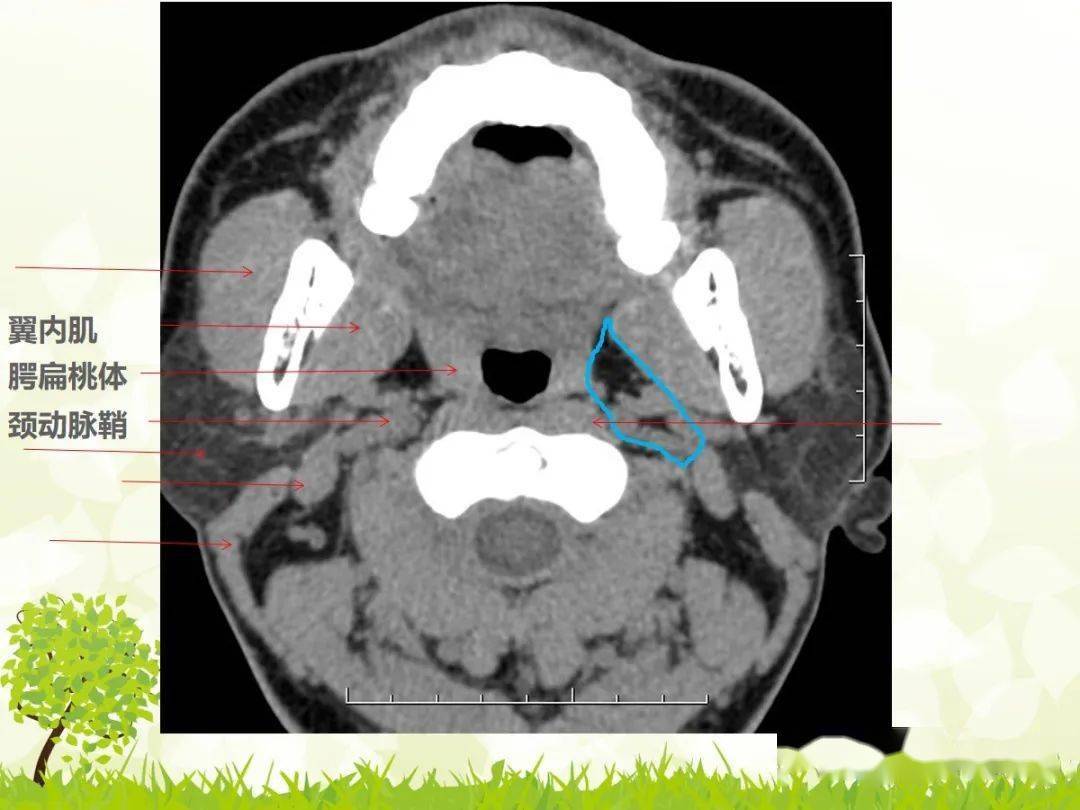 咽旁间隙解剖及常见病变影像表现