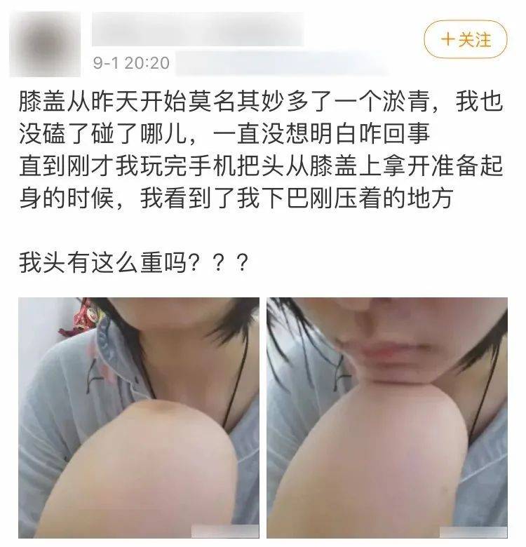 廈門男子發帖:異地戀女友的膝蓋有淤青,我是被綠了嗎?網友:恭喜恭喜!