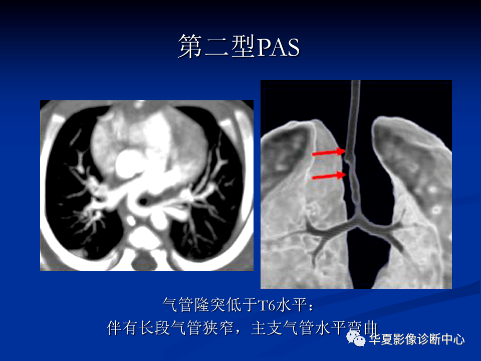 肺动脉常见病变的影像学表现