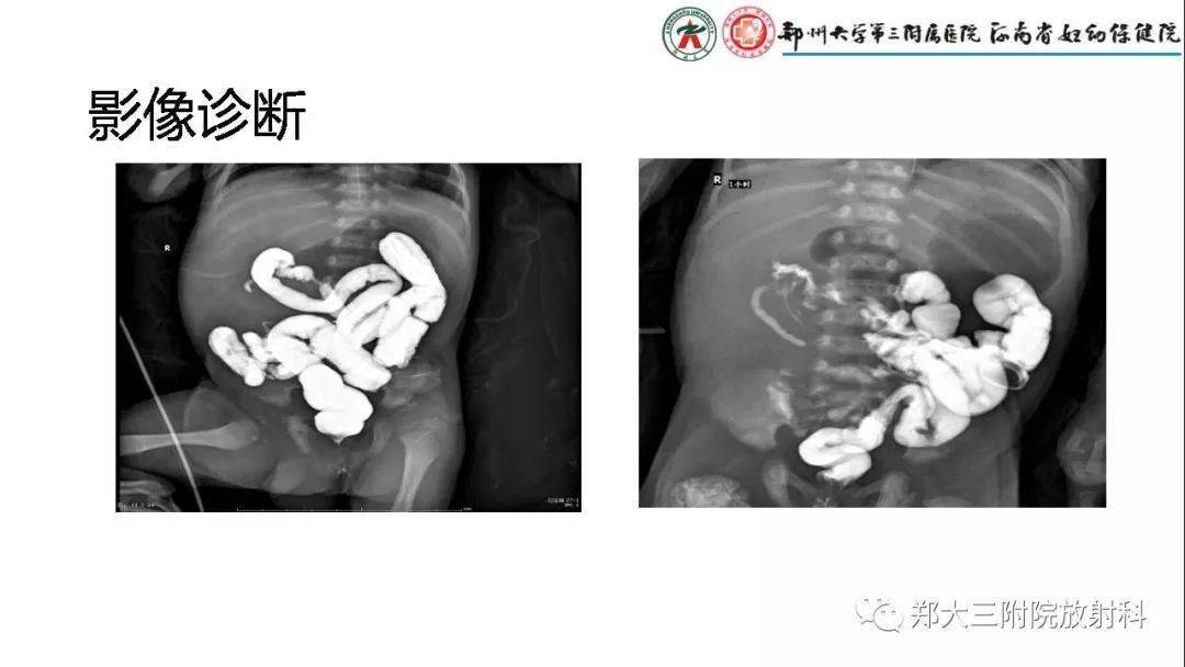 先天性肠旋转不良的影像诊断