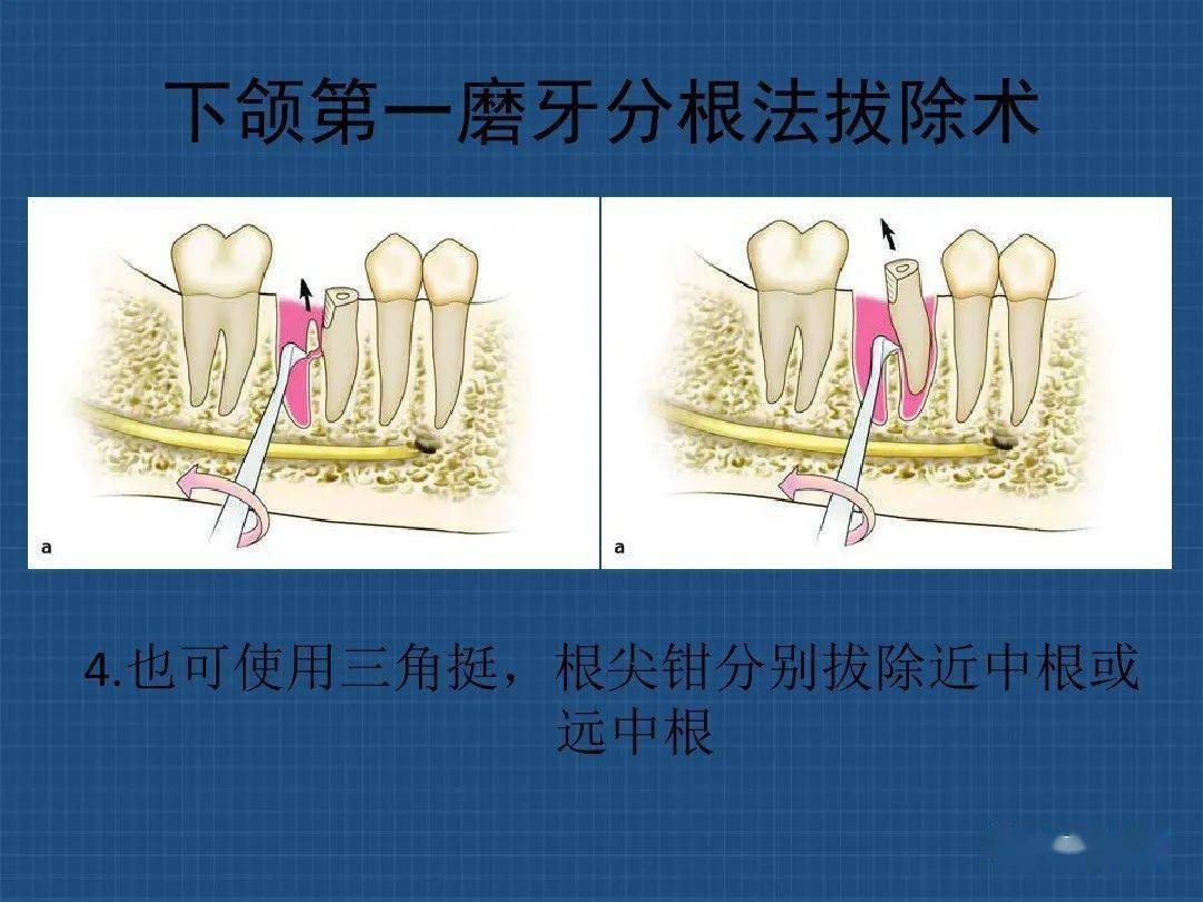 上下颌多根牙分根法