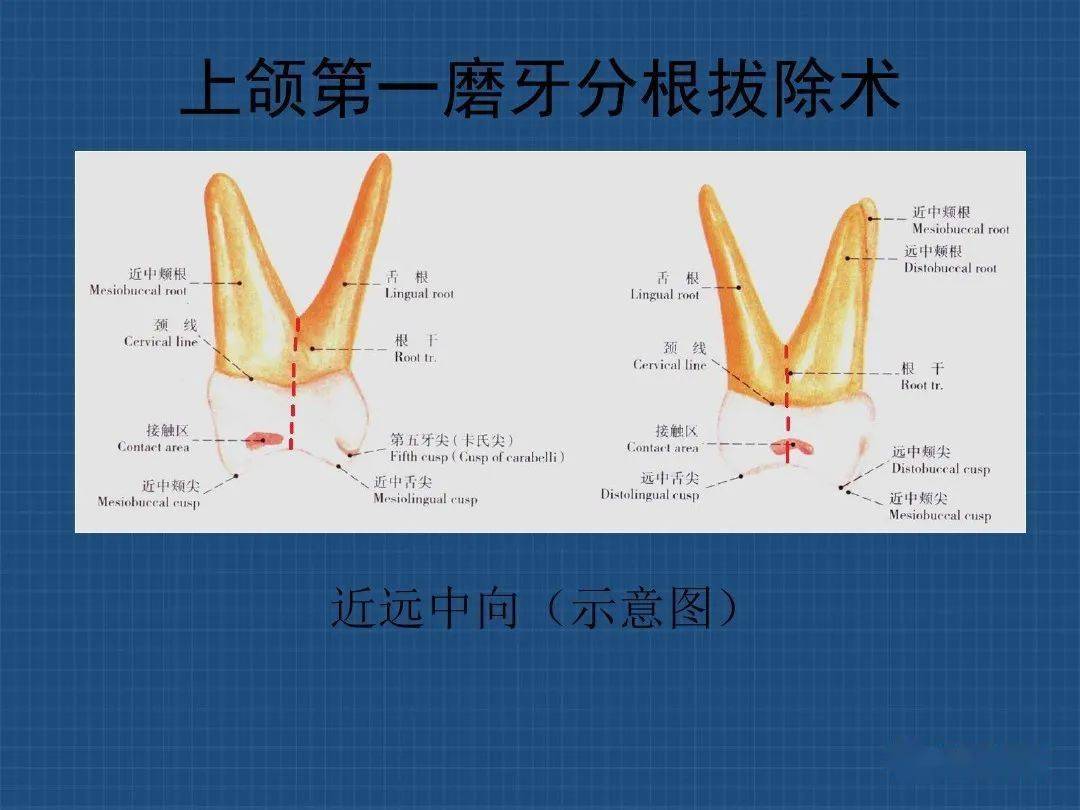 上下颌多根牙分根法